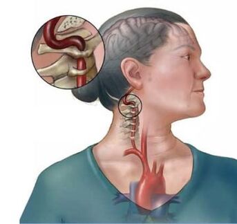 Osteokondrosia cervikalak bizkarrezurraren disko intervertebralen suntsipena dakar