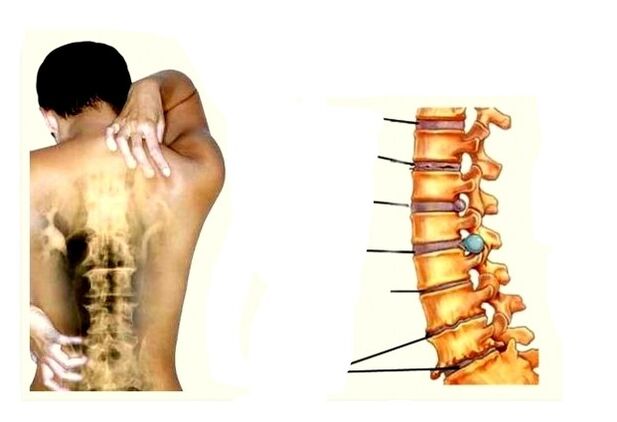 Osteokonondrosaren garapen faseak