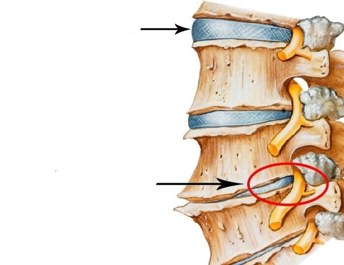 kaltetutako diskoa eta nerbio urratua osteochondrosis cervikala