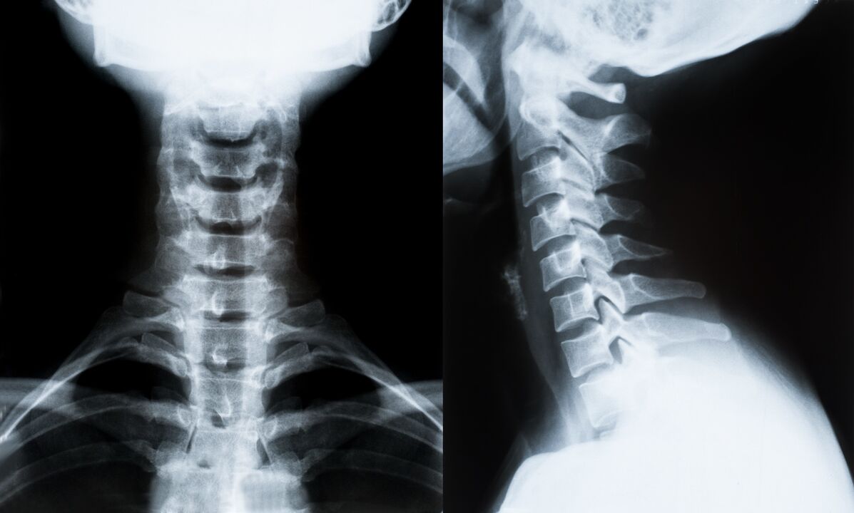 Trápaga osteokondrosia X izpietan